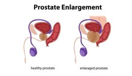 kaloithis-iperplasia-prostati-sigchroni-antimetopisi