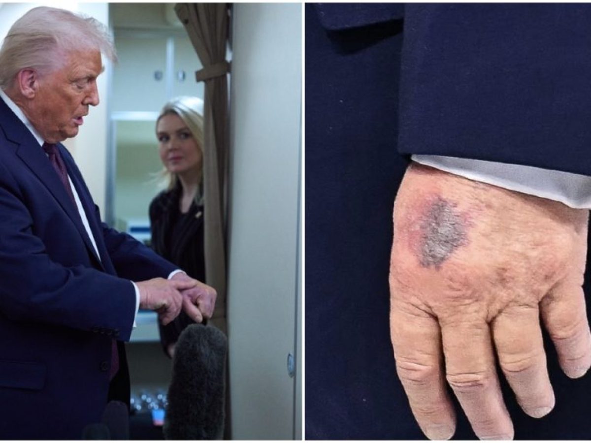 Μελανιά στο χέρι του Τραμπ στο Νταβός: «Το χτύπησα στο τραπέζι» – Αναφορά και στη λήψη ασπιρίνης