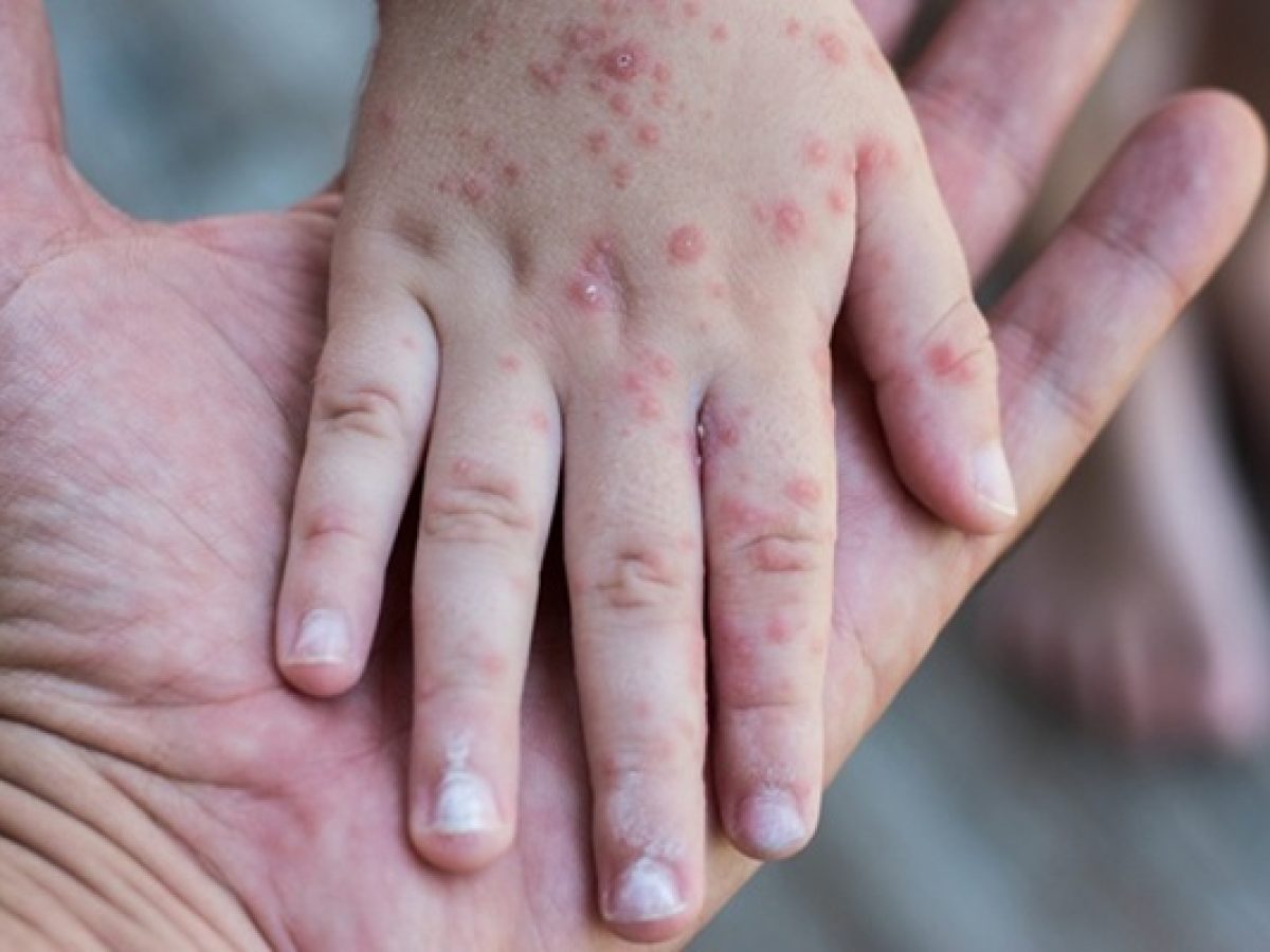 Σε έξαρση ο ιός Κοξάκι στα παιδιά