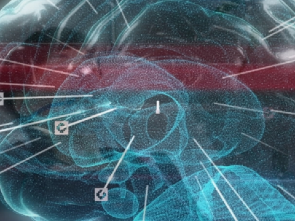 Στένωση καρωτίδων: Το «σιωπηλό» αίτιο του εγκεφαλικού επεισοδίου