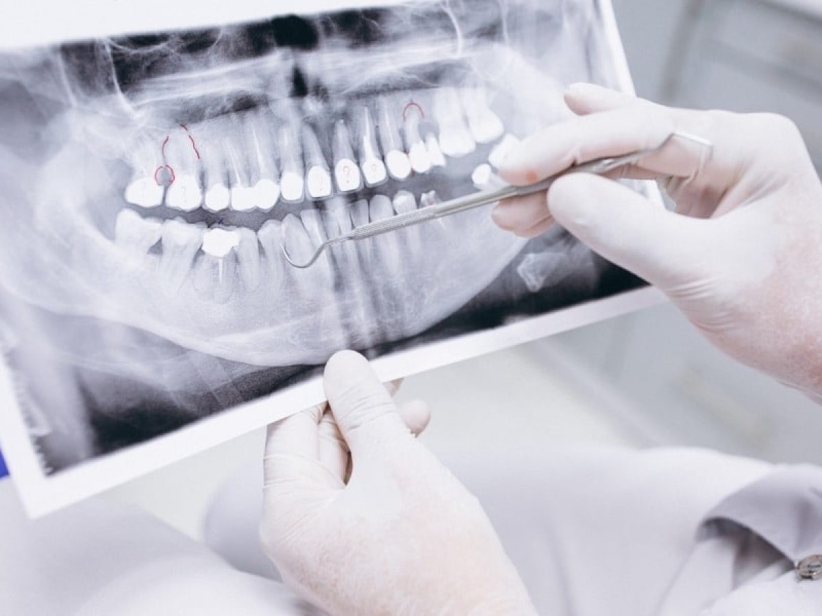 Ο άνδρας από τη Μαλαισία που έχει τα περισσότερα δόντια στον κόσμο: Πόσα είναι και τι πάθηση έχει