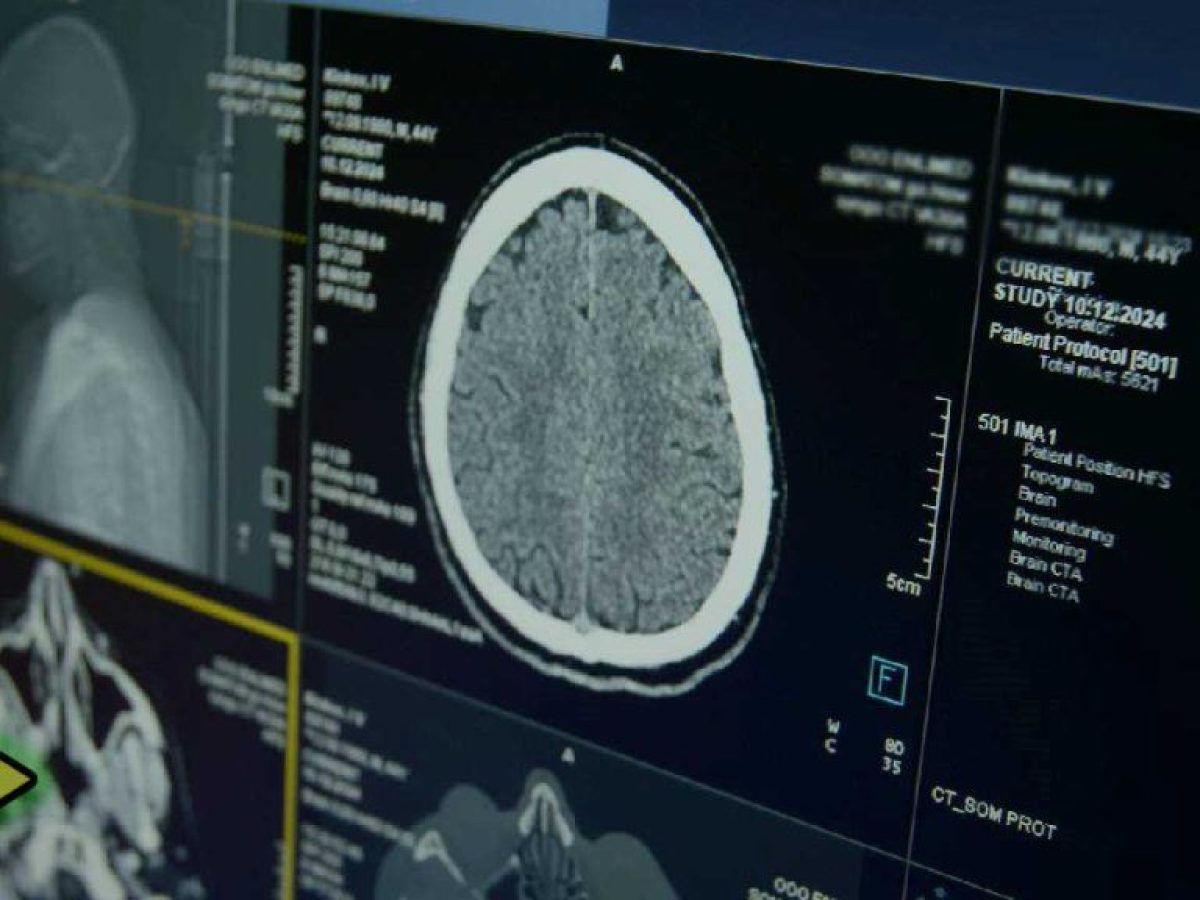 Τσιπ στον εγκέφαλο; Η νέα τεχνολογία που ανοίγει ερωτήματα για το μέλλον του ανθρώπου