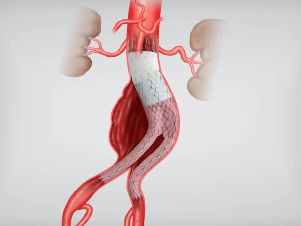 Δήμος Νέας Προποντίδας: Δωρεάν Προληπτικός Έλεγχος για το Ανεύρυσμα Κοιλιακής Αορτής – «Η Πρόληψη Σώζει Ζωές»